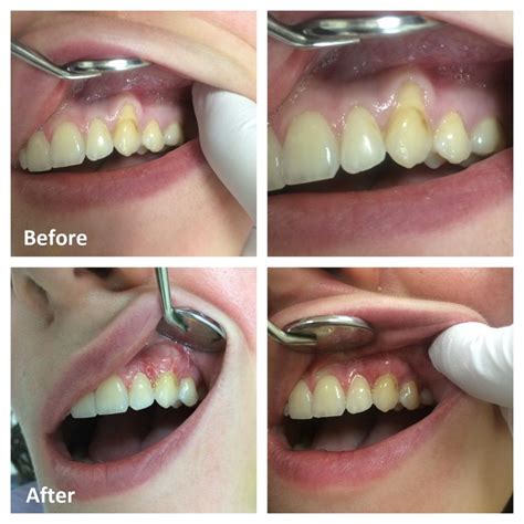 Gum Grafting Treatment .